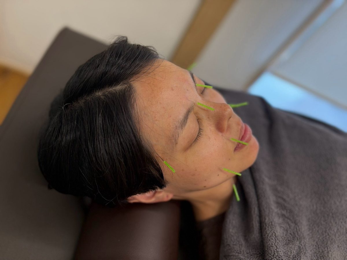 オプションの美容鍼の様子